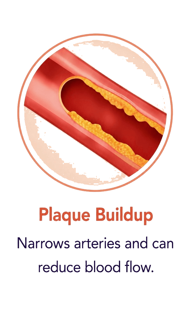 Artery with plaque buildup